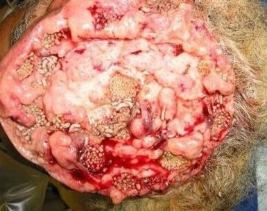 parasiidid inimese ajus